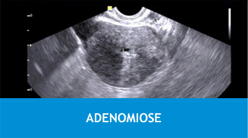 ADENOMIOSE