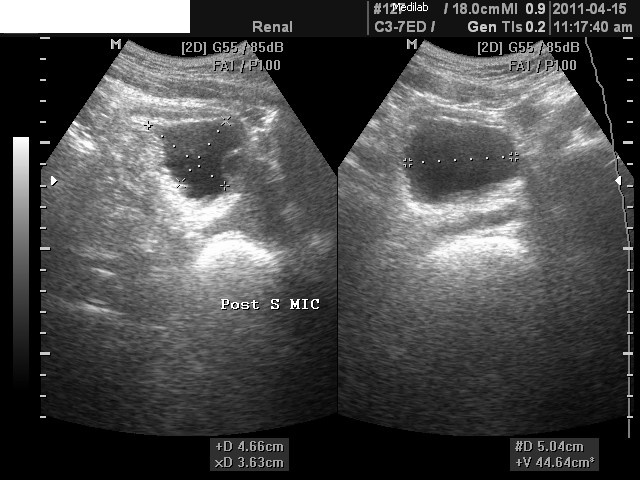 BEXIGA - URETEROCELE