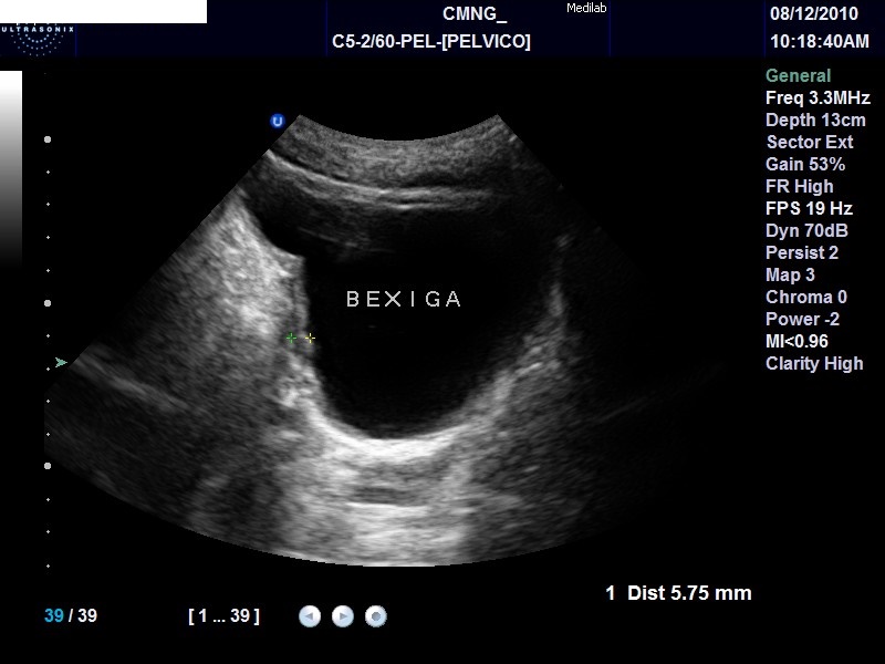 BEXIGA - RESÍDUO AUMENTADO POR ESFINCTER HIPERETONICO